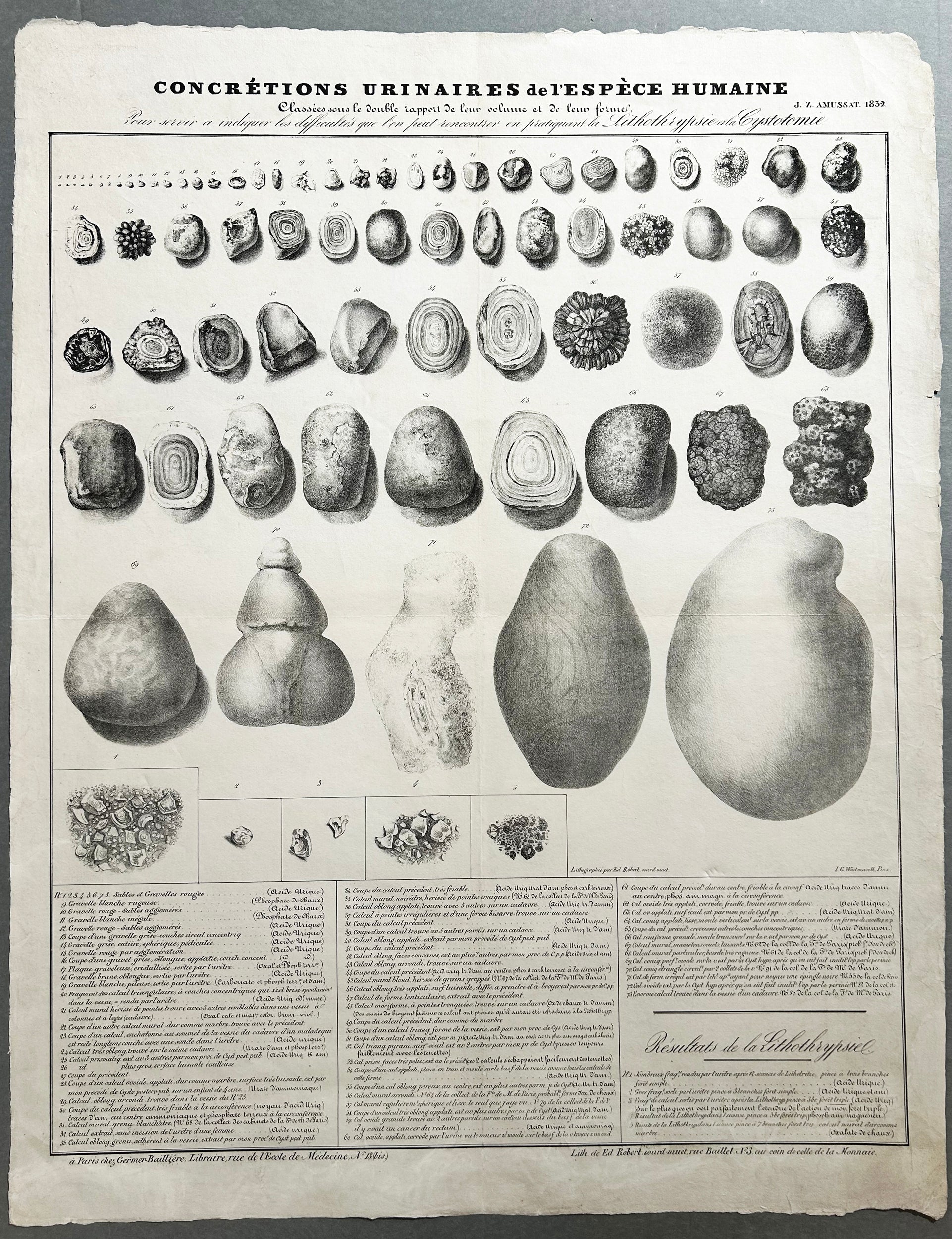 Concrétions urinaires de l'Espèce Humaine classées sous le double rapport de leur volume et de leur forme... 1832. Lithographie.